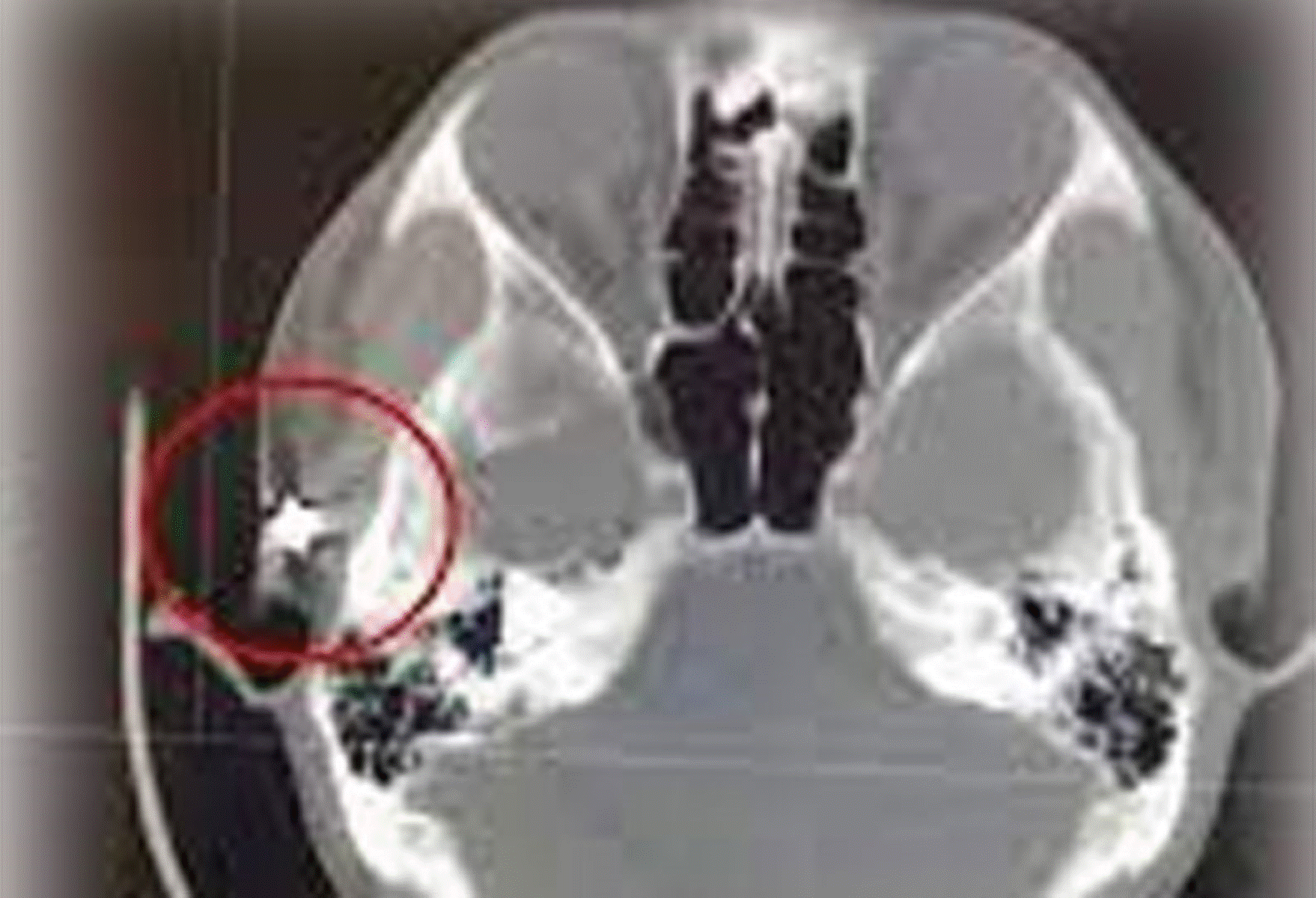 தீராத தலைவலியால் அவதிப் பட்ட நபர்! மருத்துவர்கள் தெரிவித்த அதிர்ச்சி தகவல்!