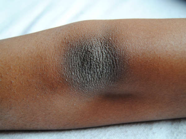 முழங்கை கருமை நீங்க! இதனை செய்து பாருங்கள்!   