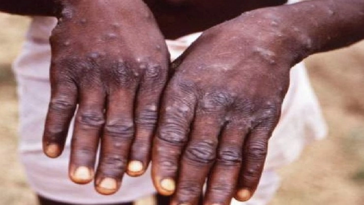 குரங்கம்மையை பற்றி தவறான தகவல்களை பரப்ப வேண்டாம் !!மனவருத்தத்துடன்  கேட்டுக்கொண்ட இரு நாடுகள்..