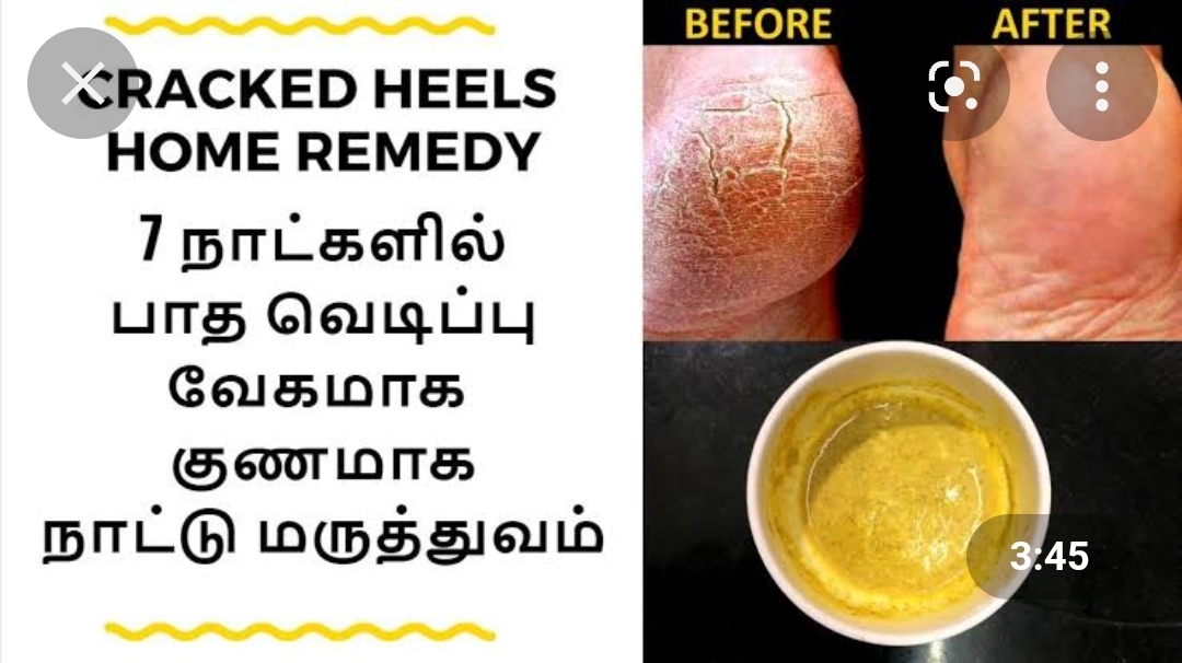 இதை ஒரு முறை செய்தால் போதும் ஒரே இரவில் பித்த வெடிப்பு மறையும்!