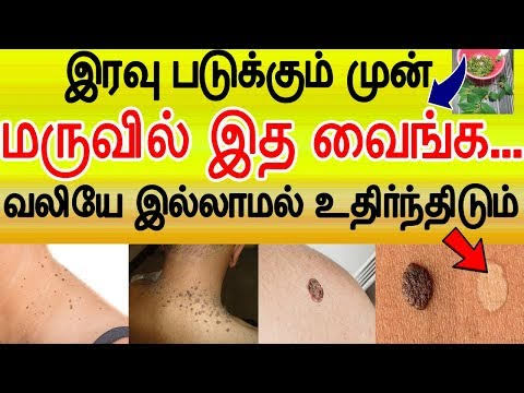 வீட்டில் இருக்கும் இந்த மூன்று பொருள் போதும் மரு தானாக உதிர!! 