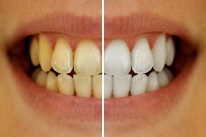 பற்களில் உள்ள கறைகள் நீங்க வேண்டுமா! நான்கு பொருட்கள் மட்டும் போதும்!