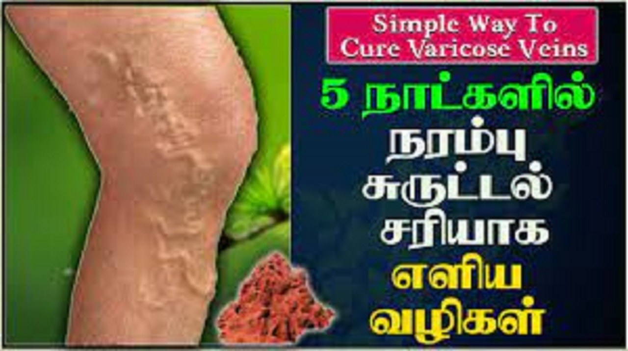 Simple Way to Cure varicose veins