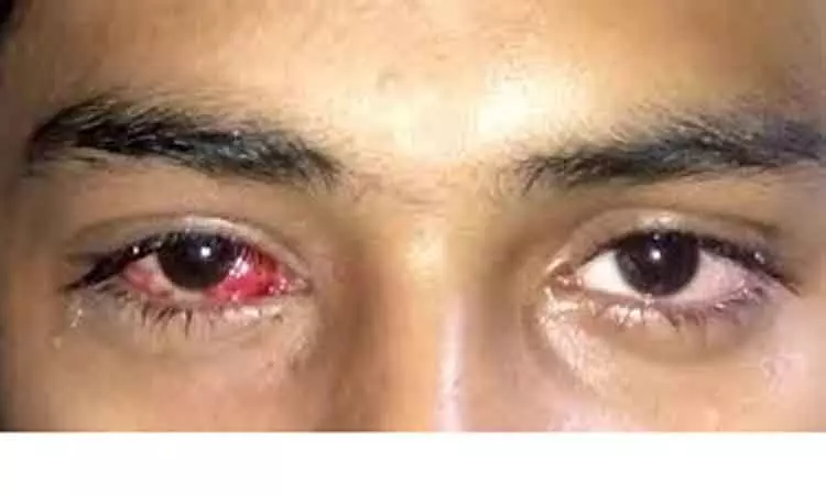 People beware! Madras Eye Invades Again!