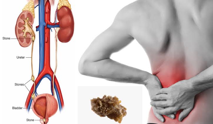 சிறுநீரக கல் கரைய வேண்டுமா? இதோ அதற்கான முழு விவரங்கள்!
