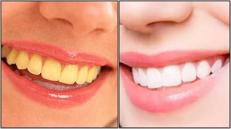 பற்கள் பளிச் பளிச் என மின்னனுமா? இதோ பல் கறைகளை போக்குவதற்கு சிம்பிள் ஐடியா! 