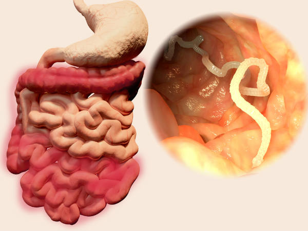 மக்களே உஷார்!! வயிற்று புழுக்களால் இவ்வளவு பிரச்சினைகளா!!