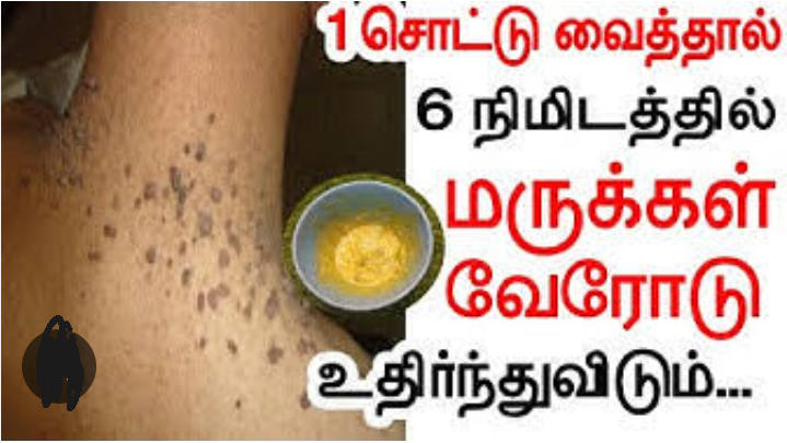 வீட்டில் இருக்கும் இந்த இரண்டு பொருள் போதும்.. 2 நிமிடத்தில் மரு உதிரும்!!