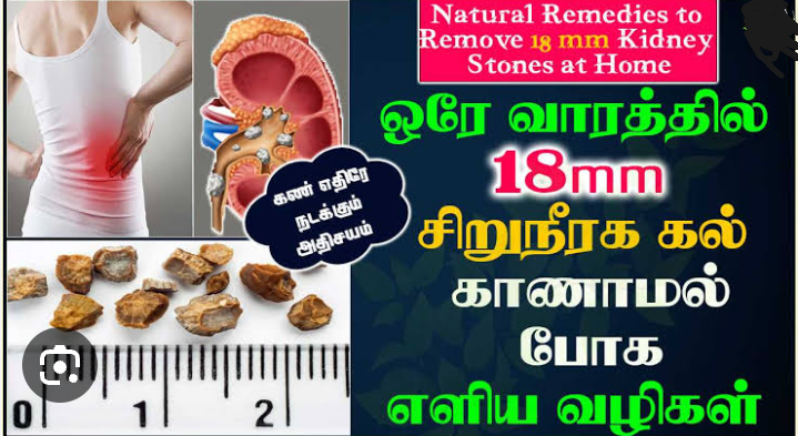 இனி ஒரு ரூபாய் கூட செலவு செய்ய தேவை இல்லை!! வலியில்லாமலேயே சிறுநீரகக் கற்களை அகற்றலாம்!!