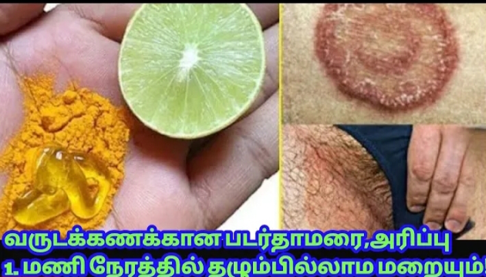 அழகைக் கெடுக்கும் படர் தாமரையினால் அவதியா?? இதை மட்டும் செய்தாலே போதும்!!