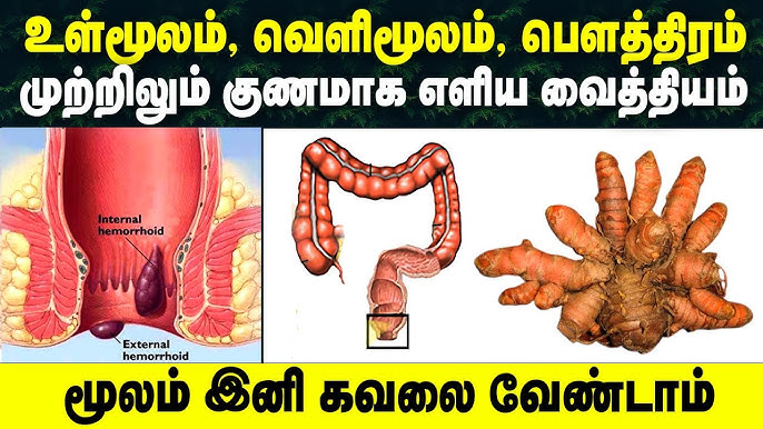 மூலம் நோய்  உங்களது கவலைக்கு காரணமா?? 5 நாட்களில் விரட்டும் அற்புத மருந்து!!
