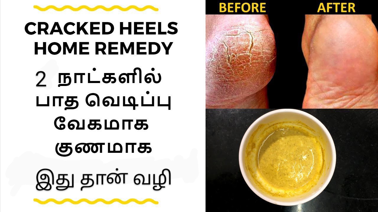 எப்பேர்ப்பட்ட பாத வெடிப்பும் 2 நாட்களில் சரியாகிவிடும்!! இதை ட்ரை பண்ணுங்க!!