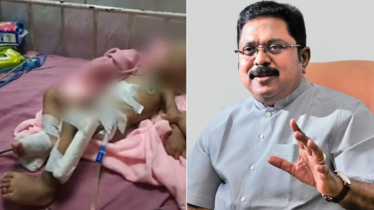 உயிரிழந்த கை அகற்றப்பட்ட குழந்தைக்கு இழப்பீடு வழங்க வேண்டும்… டிடிவி தினகரன் எக்ஸ் பக்கத்தில் பதிவு!!